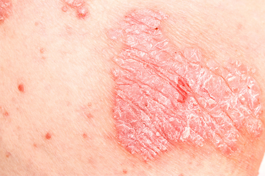 Psoriasis